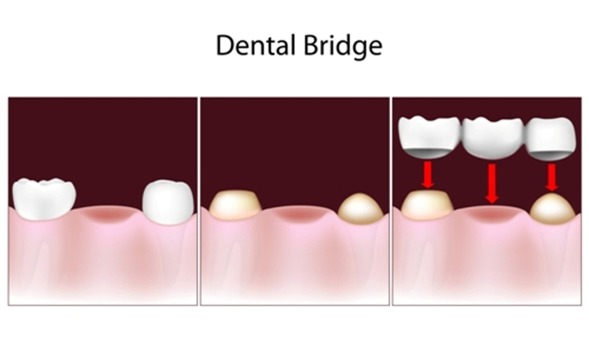 dental bridges near you