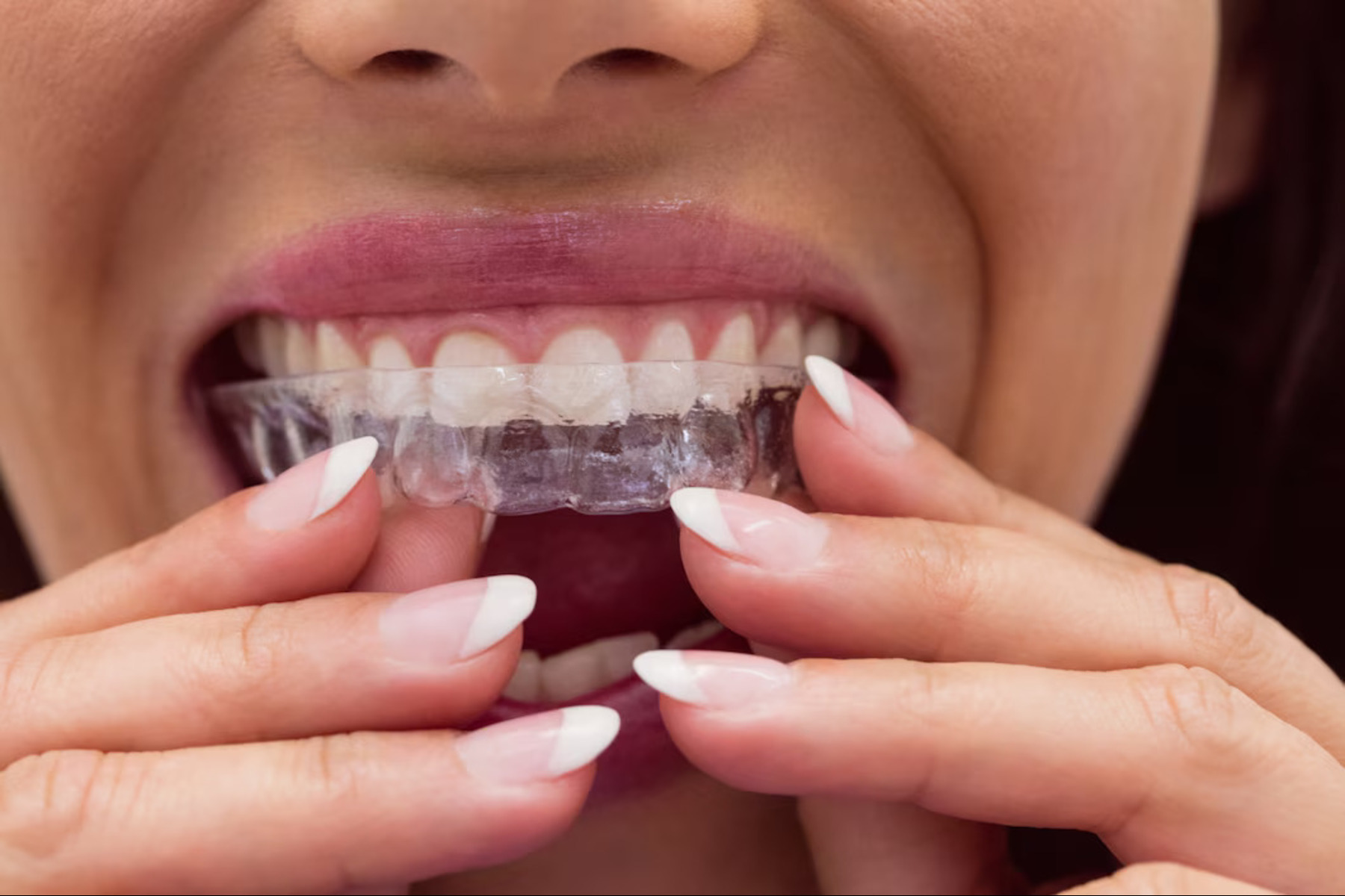 How Long Do Invisible Braces Really Take?