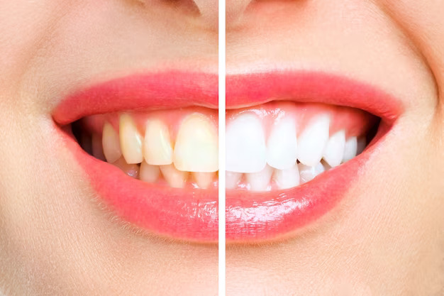 Teeth Whitening: Achieve a Brighter Smile Naturally & Professionally