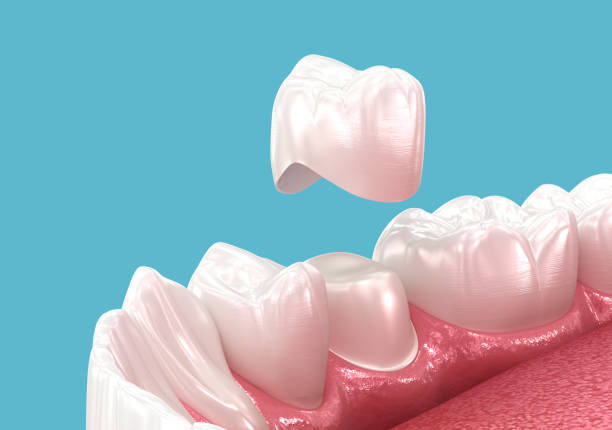 When Do You Need a Dental Crown?